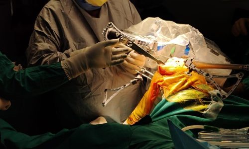 revision knee replacement